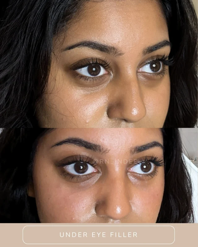 💡What’s Causing Your Under-Eye Hollows? Here's the Scoop! 💡

Ever wondered why you might notice a sunken or hollow look under your eyes? Here are some common reasons:

👁 Aging – As we age, we naturally lose collagen and fat, which makes the skin under the eyes thinner and causes hollows.
👁 Genetics – Some people are simply born with deeper tear troughs or facial structures that highlight under-eye hollows.
👁 Fat Loss – Over time, the fat pads that support your eyes can shrink or shift, leading to a more hollow appearance.
💧 Dehydration – When you're not hydrated enough, your skin can look dull, making hollows more visible.
🛏 Lack of Sleep – Poor sleep can lead to tired, sunken eyes, making under-eye hollows stand out more.
🚬 Lifestyle Factors – Stress, smoking, and poor diet accelerate skin aging, making hollows more noticeable.

But don’t worry—there are solutions! Treatments like dermal fillers, proper skincare, and simple lifestyle changes can help refresh and rejuvenate your under-eye area. ✨

Have you noticed under-eye hollows? Drop your questions below! 💬👇

#UnderEyeHollows #SkincareSolutions #YouthfulEyes #EyeCareEssentials #HealthySkin #DermalFillers #juvedermvolbella