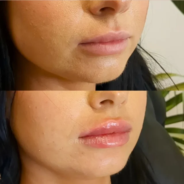 Ever wondered why some people look stunning with luscious lip fillers while others don't quite hit the mark? 
Choosing the right lip filler shape is all about harmonizing your facial features, aesthetic goals, and natural lip structure. 💋✨ Here are some tips to guide you in finding the perfect shape for your lips:

1. Consider Your Natural Lip Shape: Start by assessing your lips’ current shape and proportions. For a subtle enhancement, you might opt for shapes that enhance your natural contours, like a Cupid’s Bow or Classic Full Lips.

2. Face Shape Matters: The ideal lip shape can vary based on your overall face shape:
•	Heart-shaped faces often suit more volume in the center, like Heart-Shaped Lips.
•	Oval Faces may benefit from balanced fullness, such as Round Lips.
•	Softer shapes, like Pillowy Lips, might complement square or Angular Faces.

3. Balance with Other Facial Features: Ensure your lips harmonize with your eyes, nose, and chin. Aim for symmetry and avoid overfilling one area for a natural look unless you’re going for a dramatic effect.

4. Lifestyle and Personality: Think about how bold or subtle you want your lips to look. If you prefer a natural, soft enhancement, Classic Full Lips might be your choice. A Hollywood Lip or Keyhole Pout could be perfect if you're aiming for something more striking.

5. Consult with Your Injector: A skilled cosmetic injector can evaluate your facial structure and recommend the most flattering lip shape. They’ll consider your face proportions, lip tissues, age and personal preferences.

6. Desired Volume and Shape: Decide on the volume you want. For subtle volume with defined edges, a Cupid’s Bow might be ideal. For more fullness and plumpness, consider Pillowy Lips.

Ultimately, the best lip filler shape is the one that enhances your unique features while achieving your desired look. 💖💉

#LipFiller #Beauty #AestheticGoals #LipEnhancement #CosmeticTreatment #FaceShape #NaturalBeauty