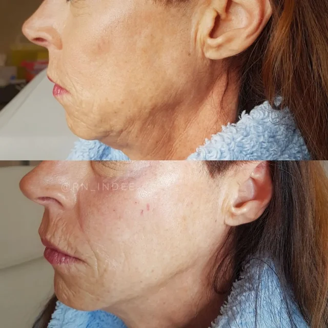 Ready to elevate your look with a subtle yet transformative touch? 💉✨ Let’s talk about chin and jawline filler! Whether aiming for a more defined jawline or enhanced chin projection, fillers can bring harmony and balance to your facial features—without looking overdone. 🙌

I focus on creating natural results that complement your unique facial structure. No sharp angles or exaggerated features—just a refined, sculpted profile that boosts your confidence and highlights your natural beauty. 💫

Did you know that chin and jawline fillers are one of the most popular treatments for enhancing the face? Not only do they define and contour, but they also give the illusion of a slimmer face and stronger profile, perfect for those looking to achieve a more youthful look. 👏

🔍 Here’s why people LOVE chin and jawline filler: ✨ Non-surgical with minimal downtime ✨ Instant, natural-looking results ✨ Long-lasting (up to 12-18 months!) ✨ Enhances facial harmony and balance

💡 Curious about how this treatment could work for you? Drop your questions below 👇 or DM us for a personalized consultation! Let’s get you one step closer to your #GlowUp ✨

Tag someone who’s been thinking about fillers and share the beauty secret! 💬

#ChinFiller #JawlineGoals #ProfilePerfection #ConfidenceBoost #AestheticJourney #FacialEnhancement #NaturalResults #BeautyBoost #GlowUp #JawlineContour #SubtleEnhancement #JawlineFiller #NaturalEnhancement #FacialHarmony #SubtleResults #ProfilePerfection #NonSurgical #ConfidenceBoost #AestheticGoals #GlowUp"