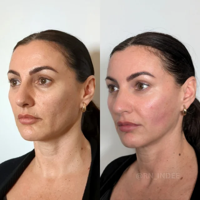 ✨ What is Full Facial Balancing with Dermal Fillers? ✨

Let’s talk about full facial balancing! This personalized treatment is all about enhancing your natural beauty while keeping your unique features intact. Using dermal fillers, I carefully adjust proportion, symmetry, and definition across key areas of your face to bring out your best look—subtle, refreshed, and authentically you.

Here’s the magic behind it:

🌟 Proportion: Add volume where it’s needed, like your cheeks, jawline, or temples, for a beautifully balanced appearance.
🌟 Definition: Sharpen and contour areas like your jawline or chin for a confident, defined profile.
🌟 Symmetry: Make small adjustments to even out features and create a harmonious, polished look.
🌟 Rejuvenation: Smooth out fine lines and restore youthful volume for a fresh, glowing vibe.

Every treatment is 100% tailored to YOU. My goal is to give you natural-looking results that last, helping you feel more confident and radiant every step of the way. 💉💛

Curious or ready to get started? Let’s chat about your beauty goals and create a plan that’s uniquely yours.

📩 DM me today to book your consultation or ask any questions. I’m here for you!
